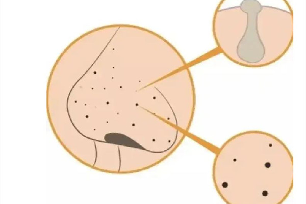 中南路夢都?巴厘女子SPA養(yǎng)生會所去黑頭后效果怎么樣 去黑頭可以去皮膚科嗎 中南路夢都?巴厘女子SPA養(yǎng)生會所去黑頭后效果怎么樣 去黑頭可以去皮膚科嗎