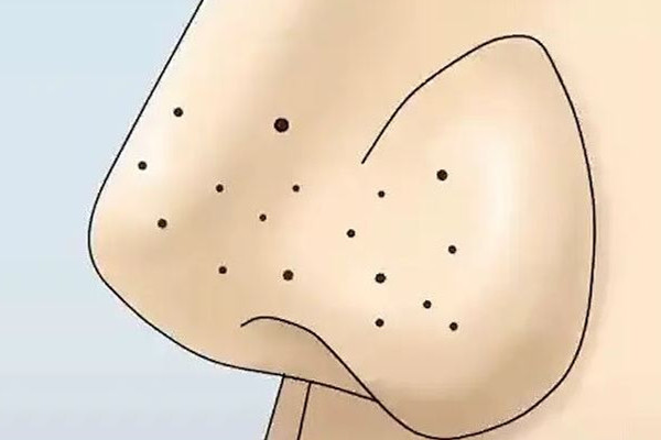 中南路熙格輕奢皮膚管理清潔鼻頭干凈嗎 黑頭可以用鑷子夾出來嗎 中南路熙格輕奢皮膚管理清潔鼻頭干凈嗎 黑頭可以用鑷子夾出來嗎