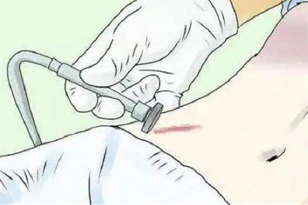 中南路欣奕除疤祛痘全國連鎖機(jī)構(gòu)祛疤效果怎么樣 祛疤是越早越好