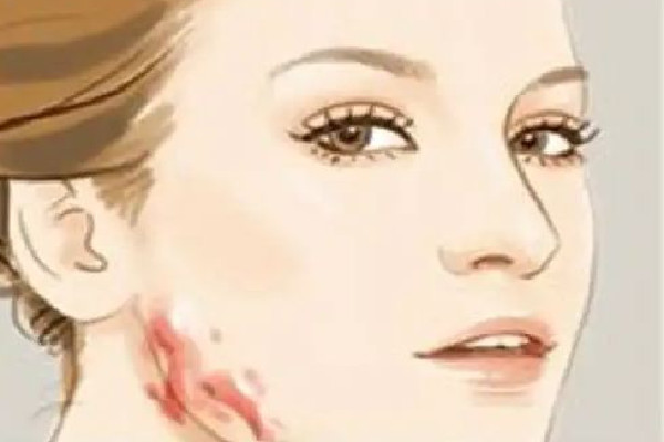 中南路欣奕除疤祛痘全國連鎖機構(gòu)祛疤效果怎么樣 祛疤是越早越好嗎 中南路欣奕除疤祛痘全國連鎖機構(gòu)祛疤效果怎么樣 祛疤是越早越好嗎