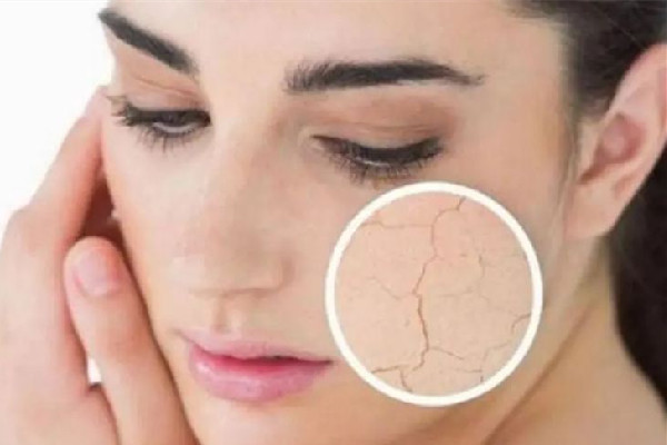 中南路丹鳳眼國際眼部美容連鎖機構可以緩解面部干燥嗎 面部干燥怎么補水效果好 中南路丹鳳眼國際眼部美容連鎖機構可以緩解面部干燥嗎 面部干燥怎么補水效果好