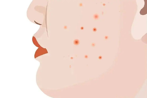 中南路Comely Lady美學(xué)中心店痘肌清潔怎么樣 痘肌多久用一次清潔面膜 中南路Comely Lady美學(xué)中心店痘肌清潔怎么樣 痘肌多久用一次清潔面膜