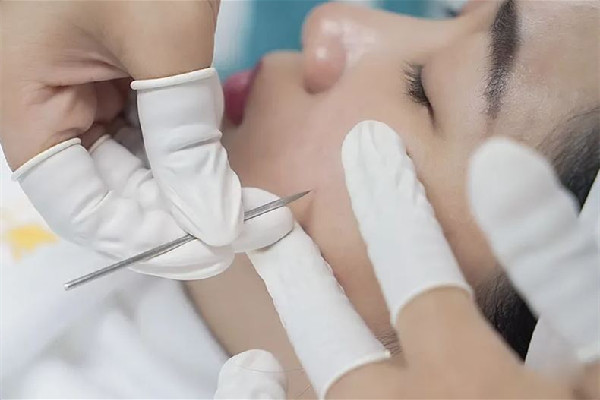 后湖SOR索爾祛痘?面部肌膚科學管理針清效果怎么樣 針清會讓毛孔變大嗎 后湖SOR索爾祛痘?面部肌膚科學管理針清效果怎么樣 針清會讓毛孔變大嗎