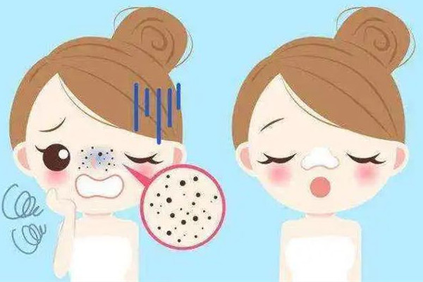 后湖skin79皮膚管理中心去黑頭干凈嗎 黑頭會自己排出來嗎 后湖skin79皮膚管理中心去黑頭干凈嗎 黑頭會自己排出來嗎