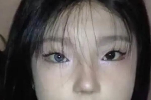 18歲女孩右眼天生藍瞳 為什么有的人瞳孔顏色不一樣 18歲女孩右眼天生藍瞳 為什么有的人瞳孔顏色不一樣
