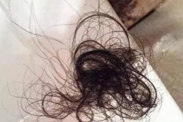 女孩吃頭發(fā)胃里取出5斤毛球 頭發(fā)吃到肚子里了有什么影響