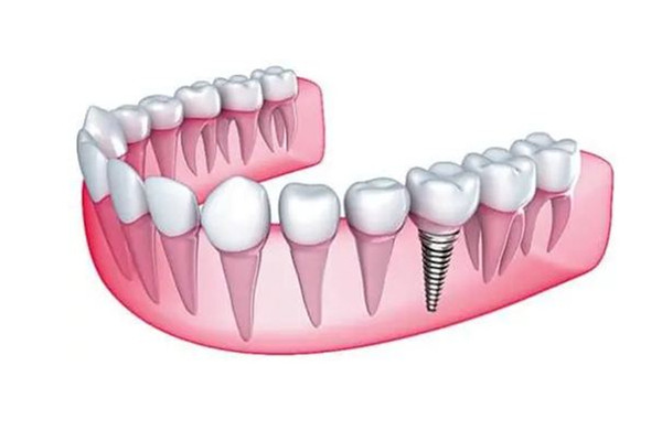多地調(diào)低種植牙醫(yī)療服務(wù)費(fèi)用 種牙醫(yī)保能報(bào)銷嗎 多地調(diào)低種植牙醫(yī)療服務(wù)費(fèi)用 種牙醫(yī)保能報(bào)銷嗎