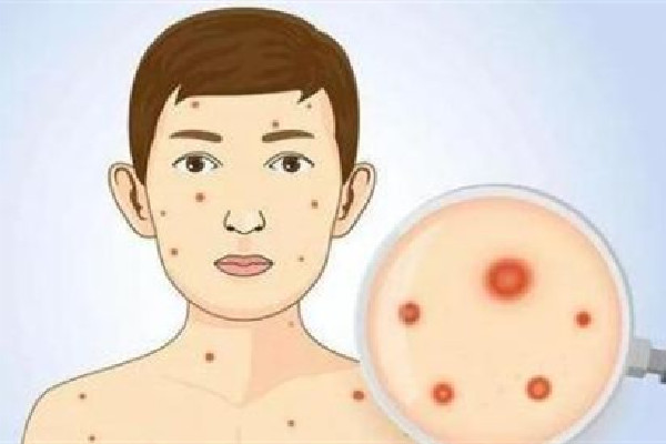 超90%的成人體內(nèi)有水痘帶狀皰疹病毒 水痘帶狀皰疹會自愈嗎 超90%的成人體內(nèi)有水痘帶狀皰疹病毒 水痘帶狀皰疹會自愈嗎