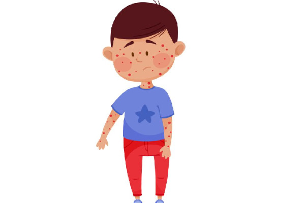 水痘進入高發(fā)期專家提醒 水痘的癥狀和治療 水痘進入高發(fā)期專家提醒 水痘的癥狀和治療