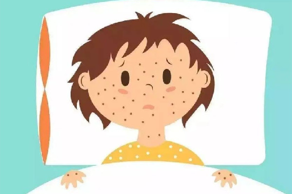 水痘進入高發(fā)期專家提醒 水痘的癥狀和治療 水痘進入高發(fā)期專家提醒 水痘的癥狀和治療