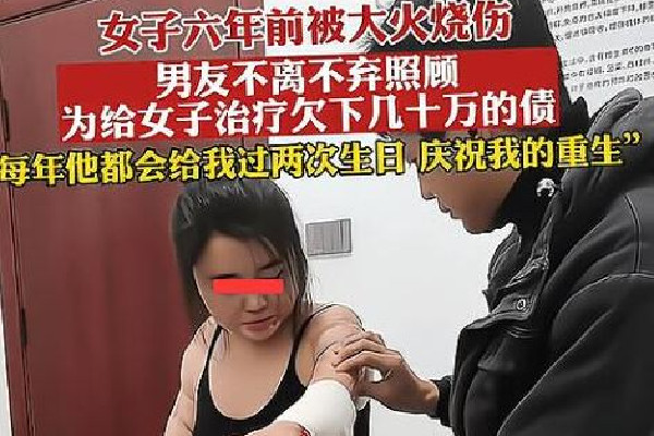 男子照顧大面積燒傷女友6年 大面積燒傷要多長(zhǎng)時(shí)間才會(huì)恢復(fù) 男子照顧大面積燒傷女友6年 大面積燒傷要多長(zhǎng)時(shí)間才會(huì)恢復(fù)