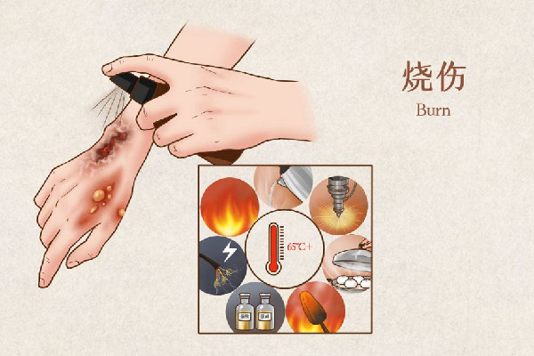 男子照顧大面積燒傷女友6年 大面積燒傷要多長(zhǎng)時(shí)間才會(huì)恢復(fù) 男子照顧大面積燒傷女友6年 大面積燒傷要多長(zhǎng)時(shí)間才會(huì)恢復(fù)