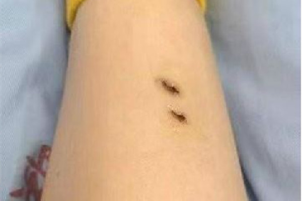 女子住酒店被毒蛇咬傷酒店拒擔(dān)全責(zé) 毒蛇一般在什么地方 女子住酒店被毒蛇咬傷酒店拒擔(dān)全責(zé) 毒蛇一般在什么地方